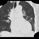 Chest tube, pleural drain: CT - Computed tomography